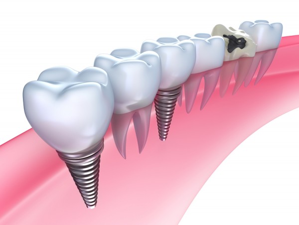 Dental implants 