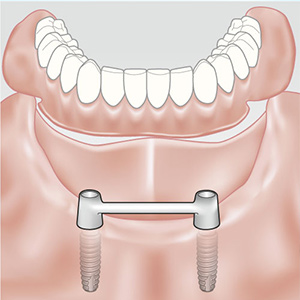 Full implant replacements - Paul Lowe Dentistry